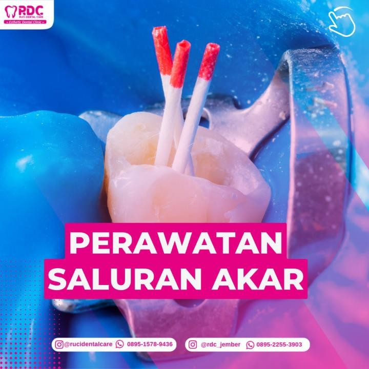Perawatan Saluran Akar (PSA)