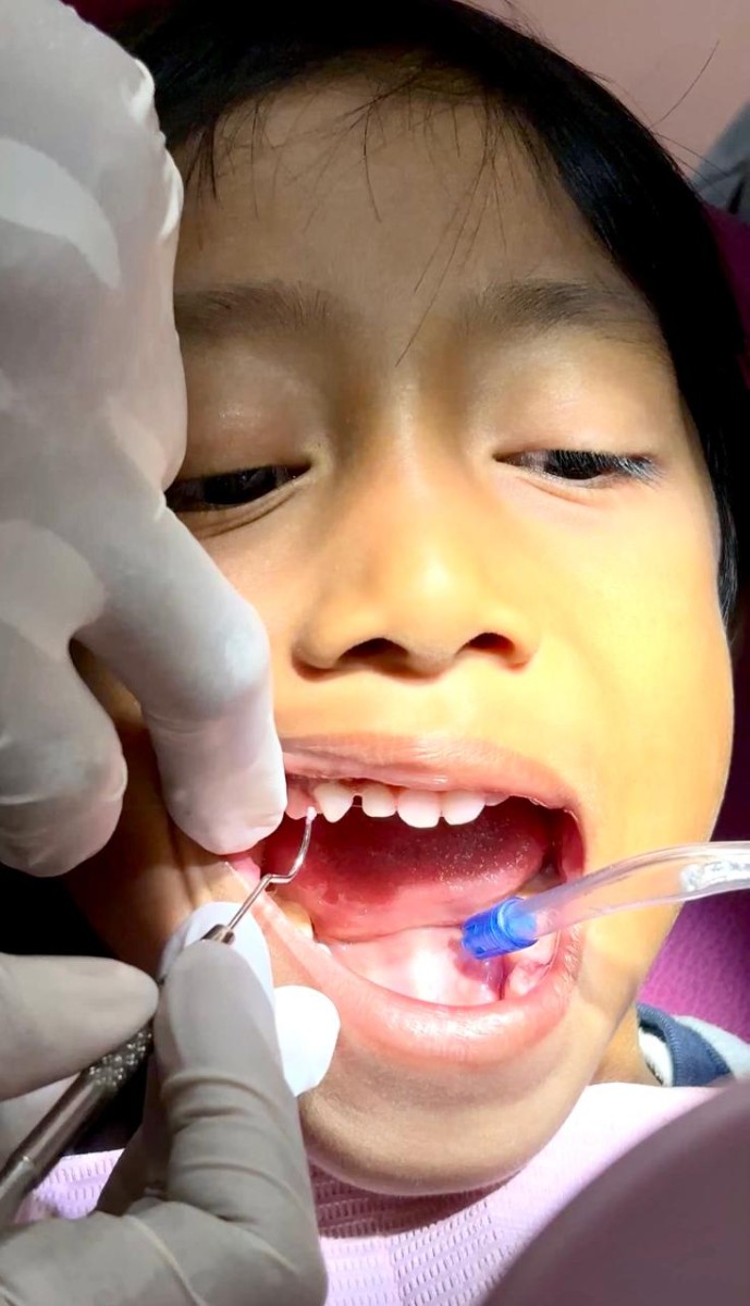 Toothspy Junior / Pendeteksi Plak Gigi
