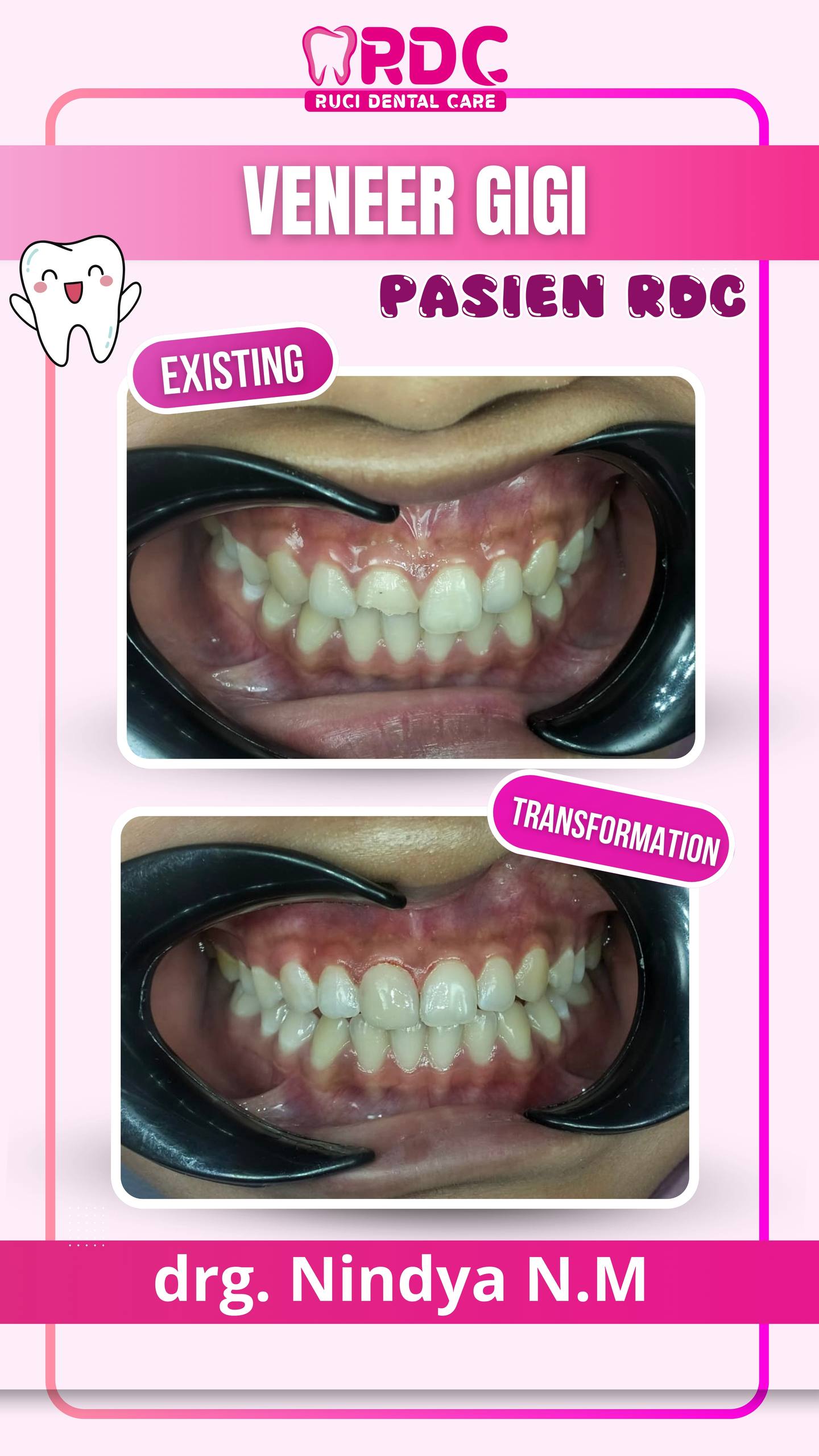 Veneer Gigi