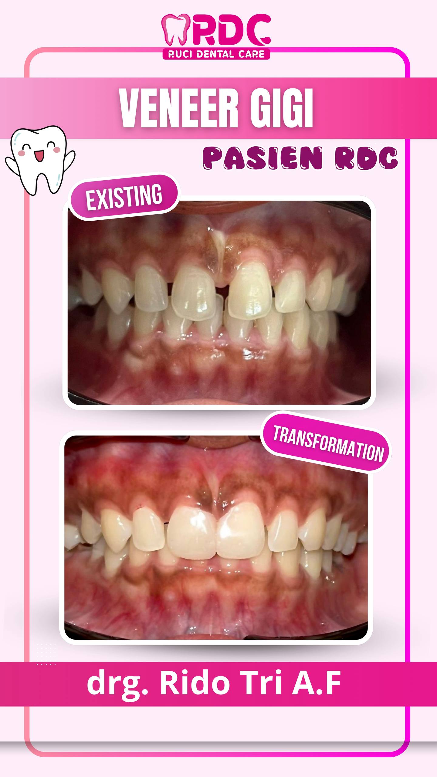 Veneer Gigi