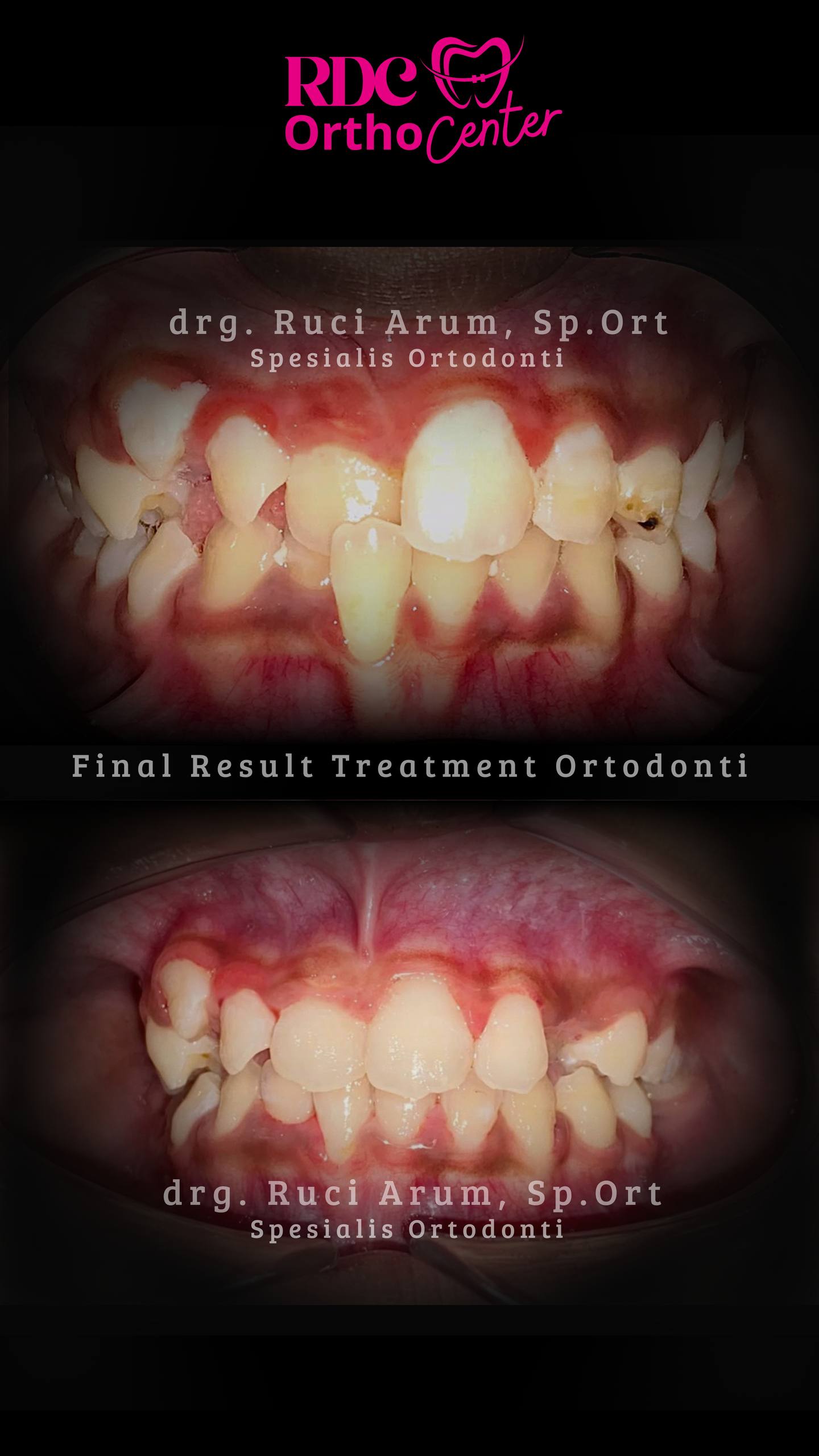 Behel Gigi / Ortodonti
